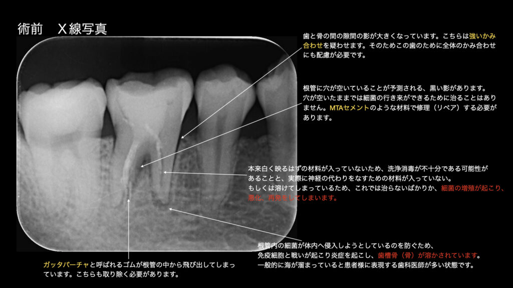 術前　解説